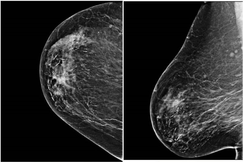 como-se-ve-una-mamografia-con-cancer